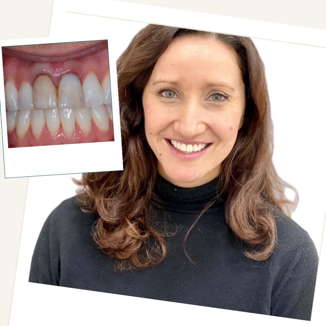 Before and after clinical results of traumatised front teeth treated with internal whitening and ceramic e.max crowns