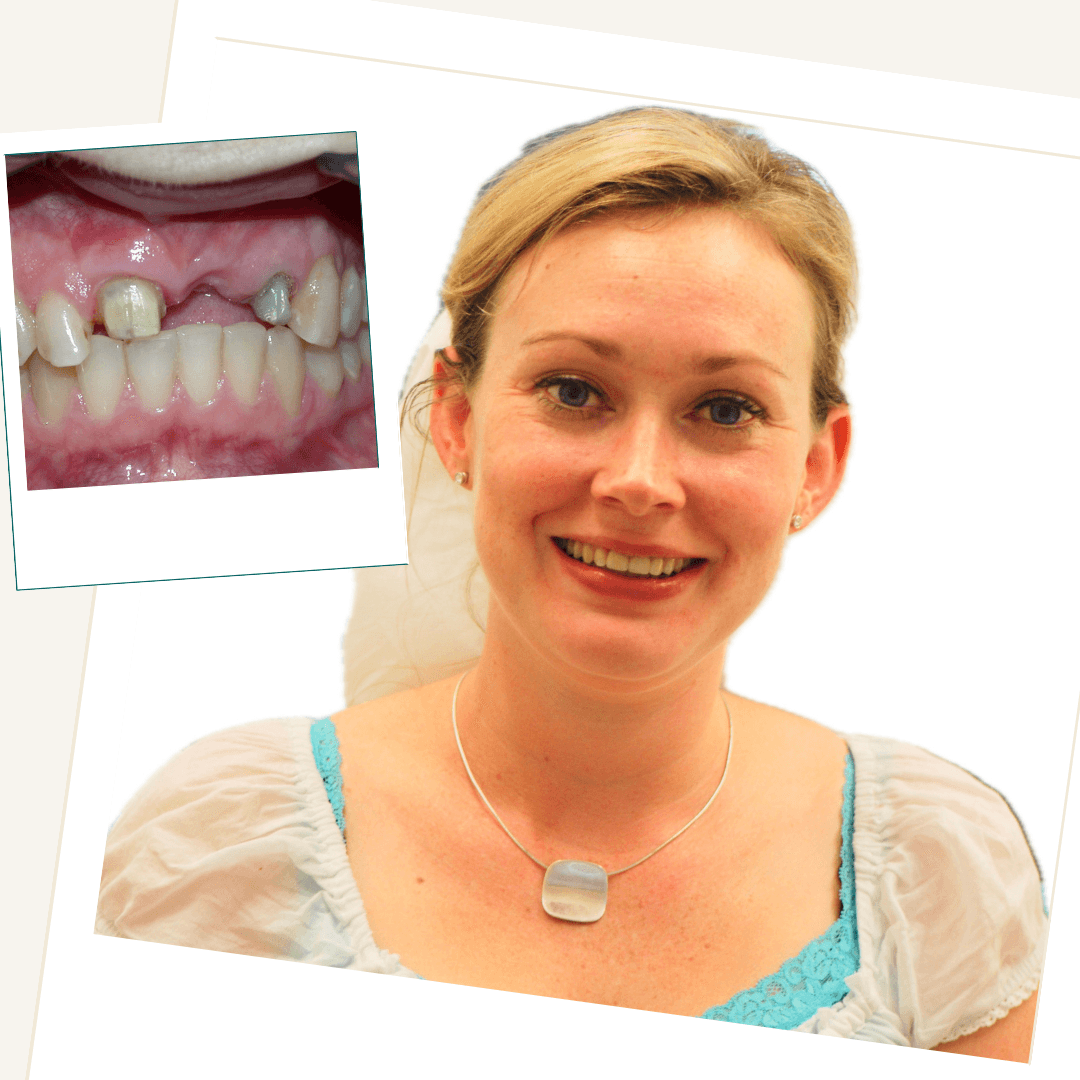 Patient after treatment with an implant-supported bridge