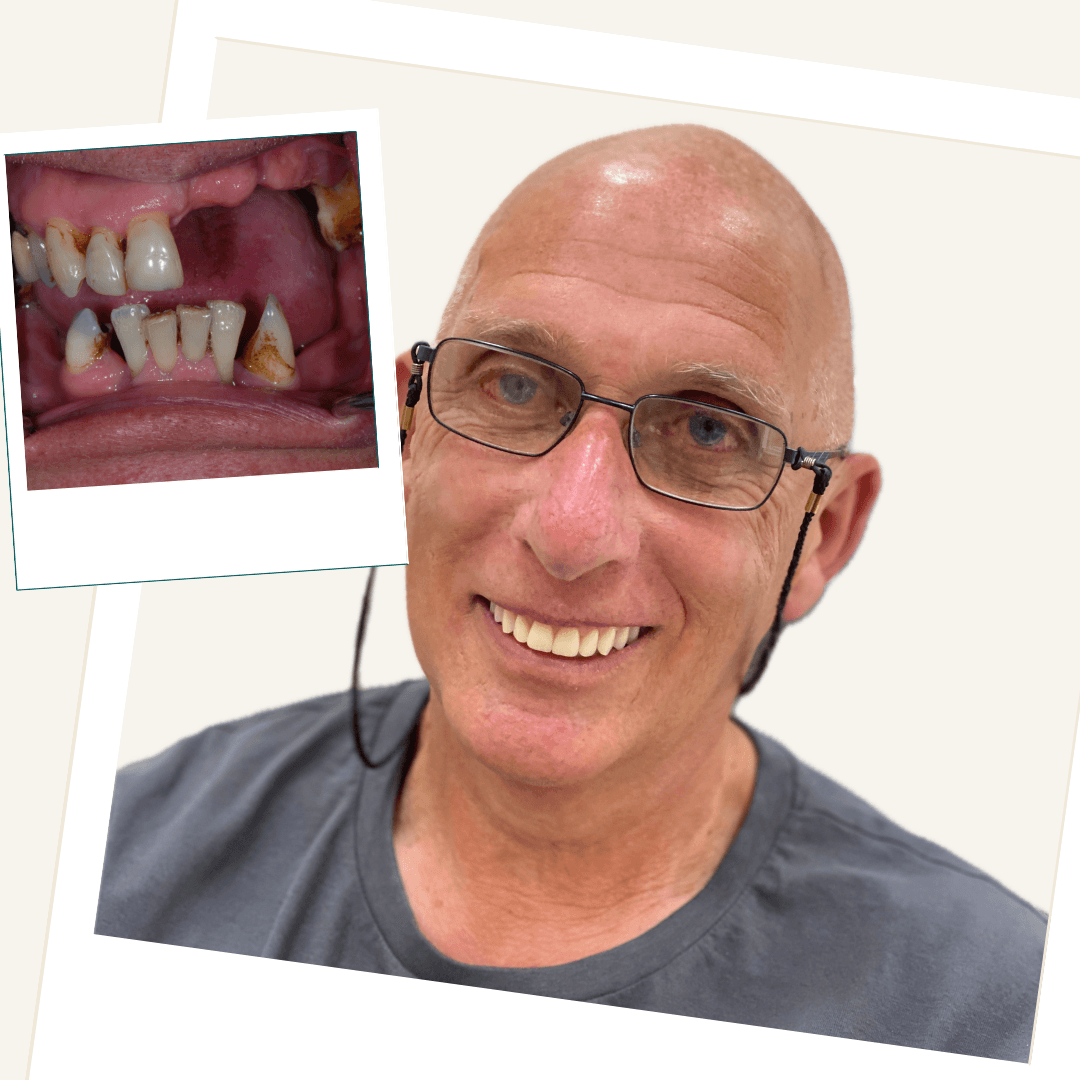 Patient with an implant-supported upper removable denture and lower fixed implant restoration