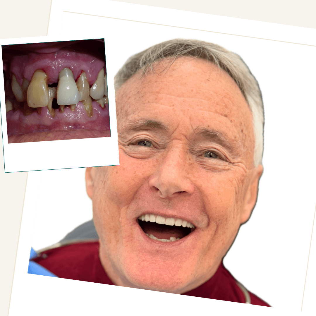 Patient after full-arch immediate implant treatment