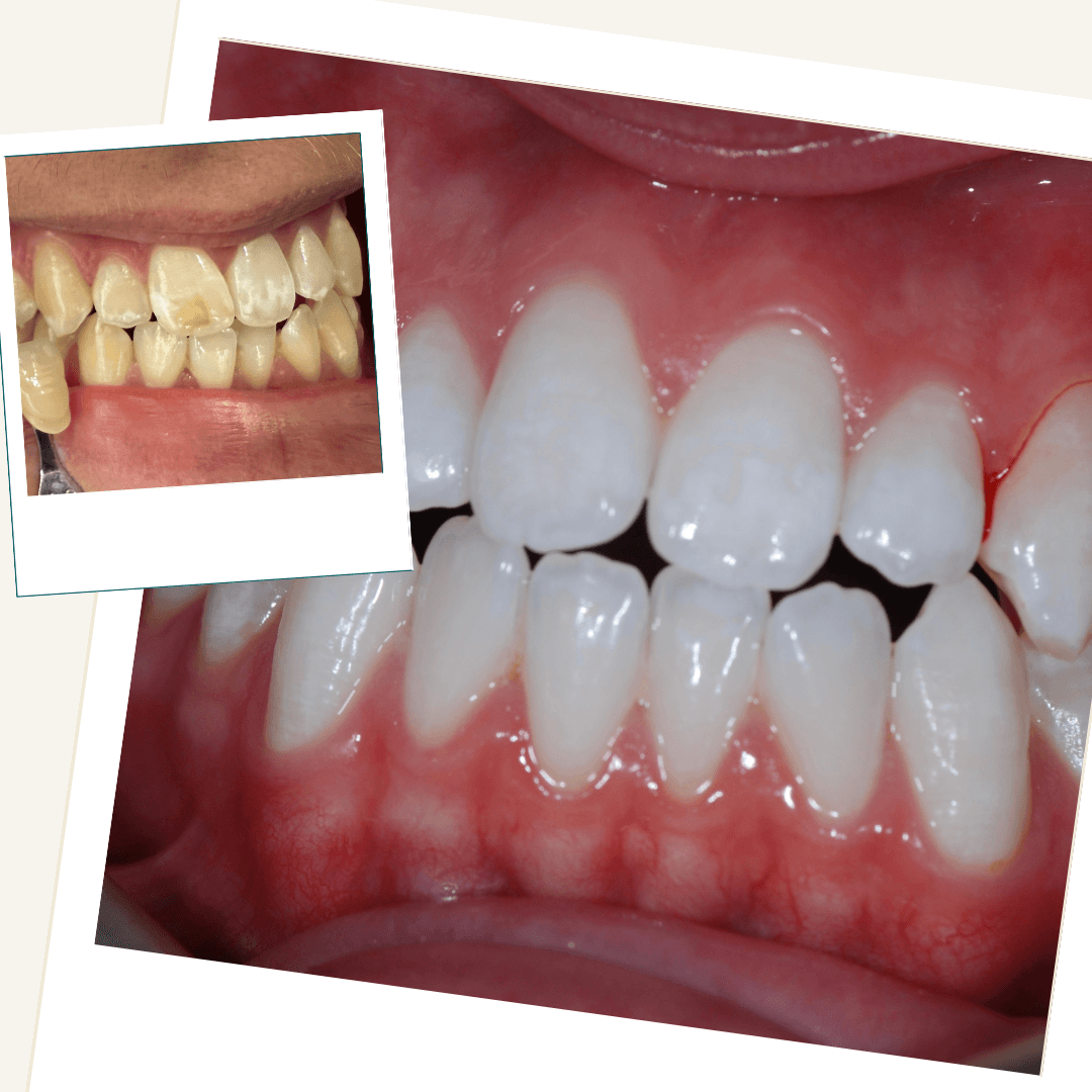 Before and after whitening and ICON resin infiltration for mottled stained teeth