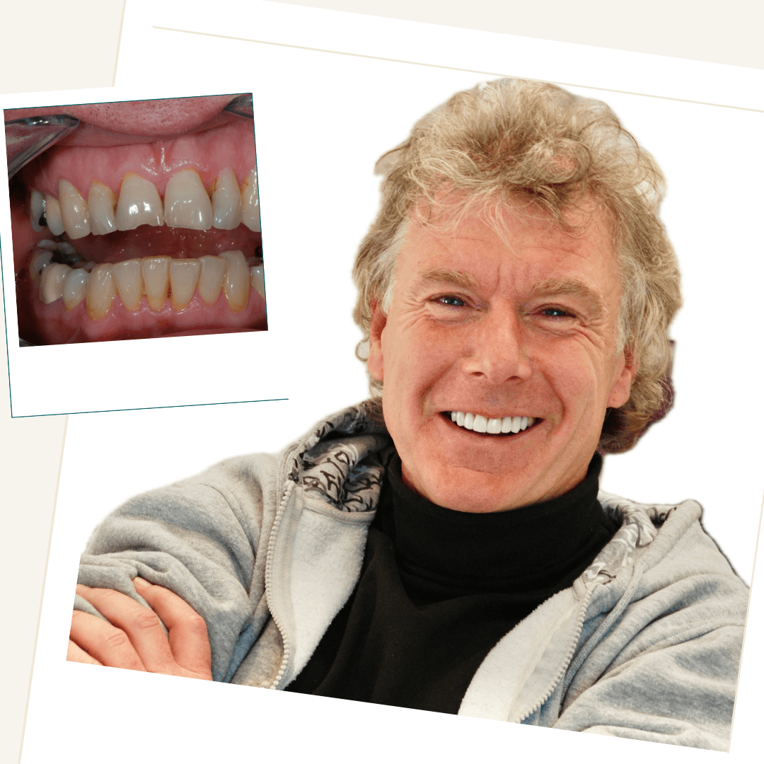 Patient result after conservative porcelain veneer treatment