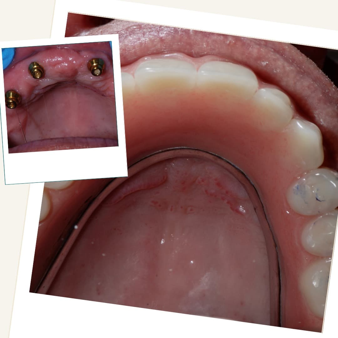 Upper arch showing implant attachments and the fitted horseshoe overdenture