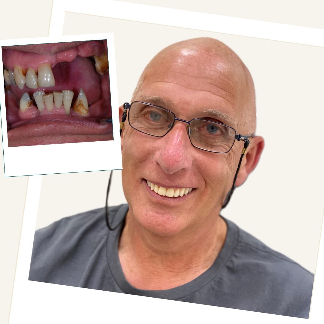 Patient following upper implant-overdenture and lower fixed-bridge treatment
