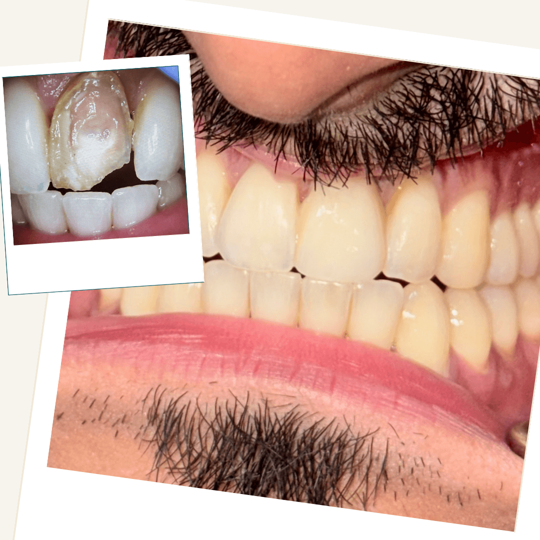 Patient result following tooth-preserving treatment, with a before-treatment inset