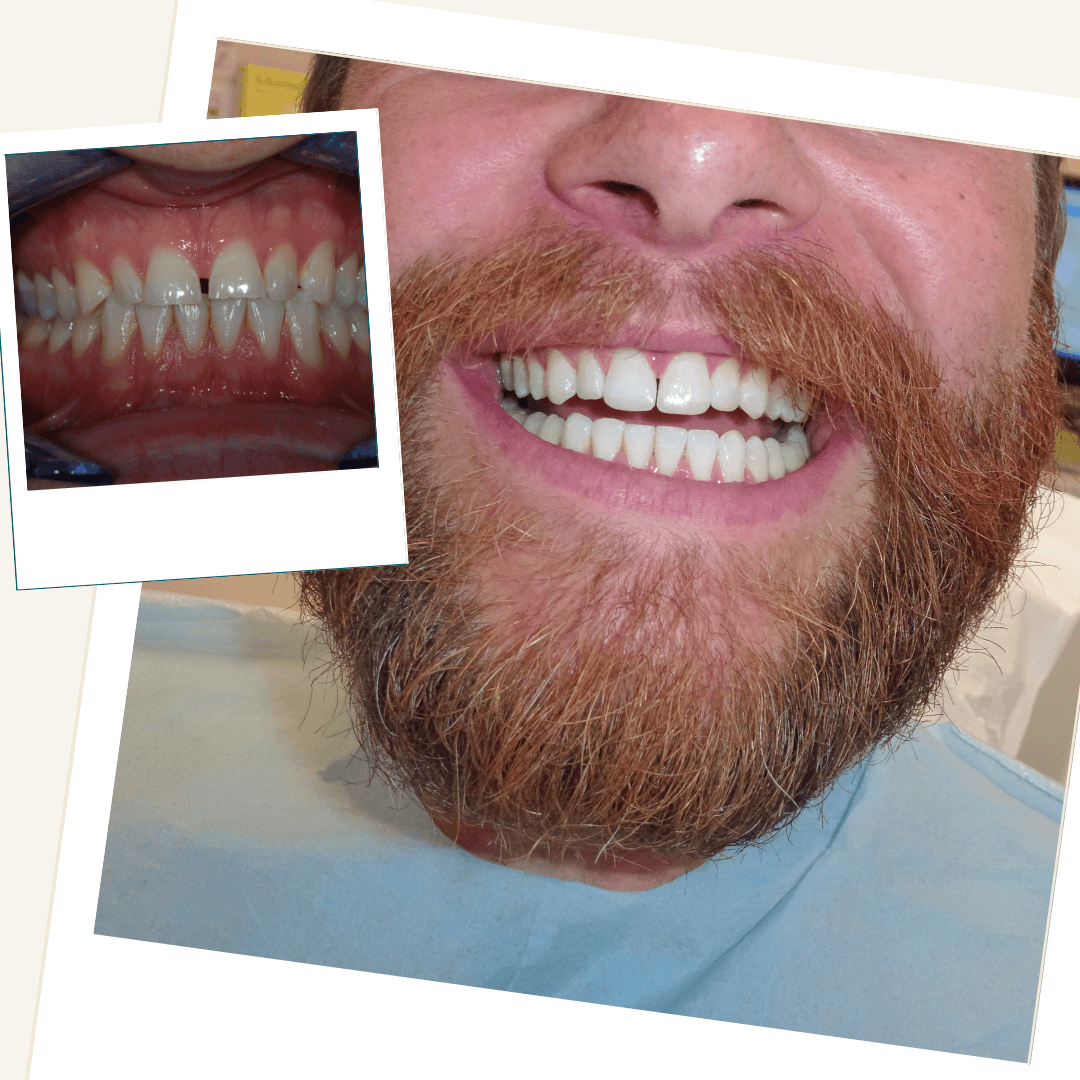 Patient following conservative tooth wear treatment, with an inset clinical view of the teeth