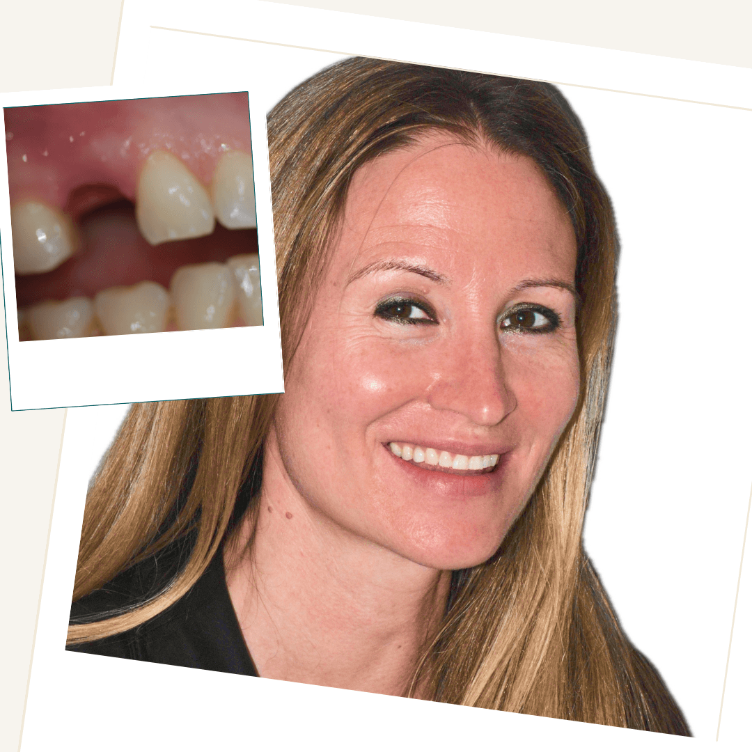 Patient following replacement of a missing front tooth with a dental implant