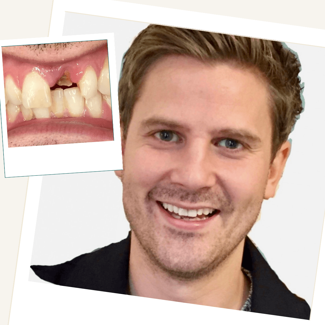 Patient after replacement of a broken front tooth with a single dental implant
