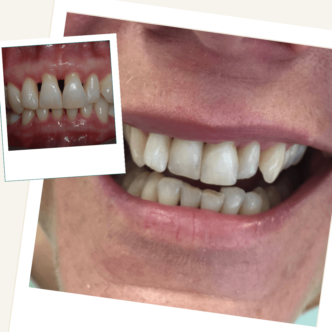 Before and after composite bonding to close gaps associated with gum recession