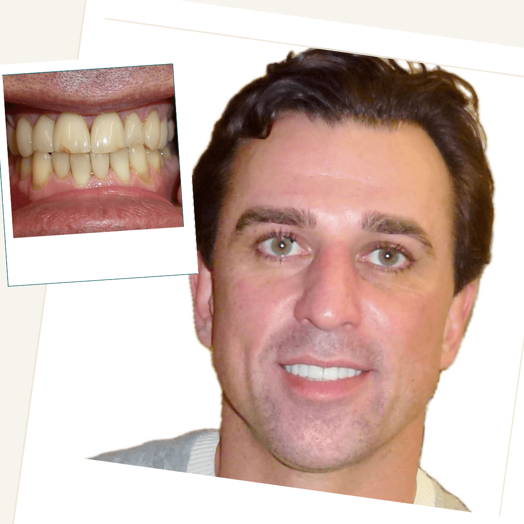 Patient before and after conservative porcelain veneer treatment